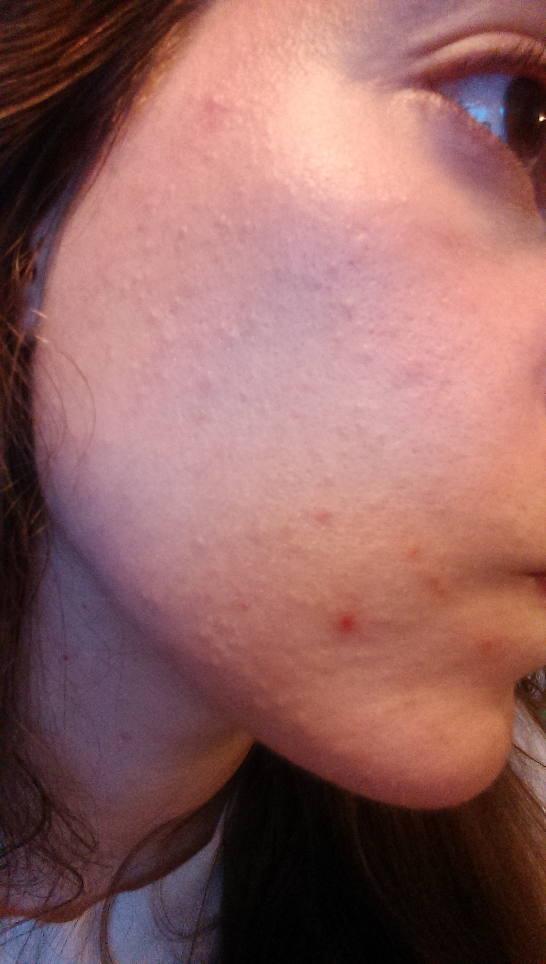 Mon traitement contre l'acné : Curacné (Roaccutane). - Les ...